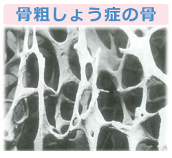 骨は若返る 骨粗しょう症治療 水戸中央病院